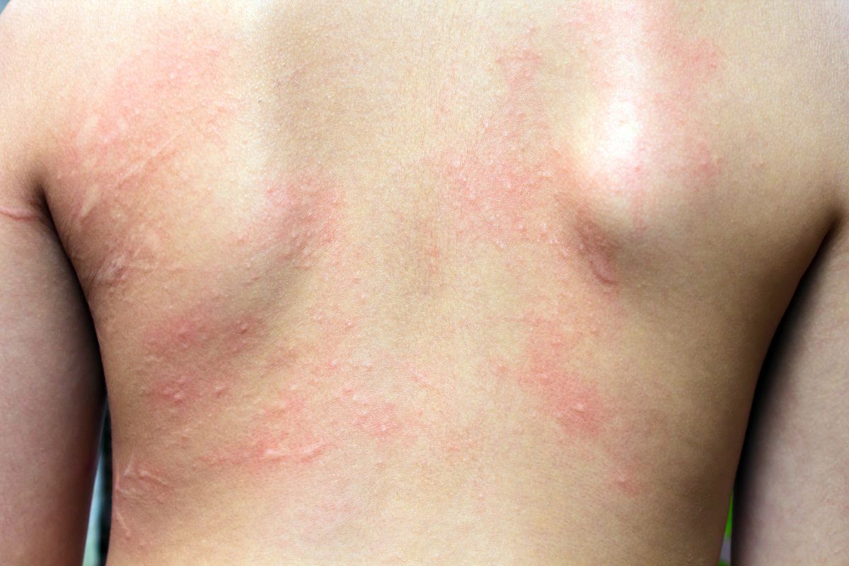 Comment apaiser les démangeaisons